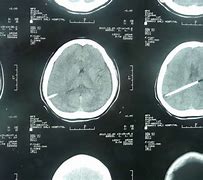 脑肿瘤伴随脑积水诊断、治疗与管理策略